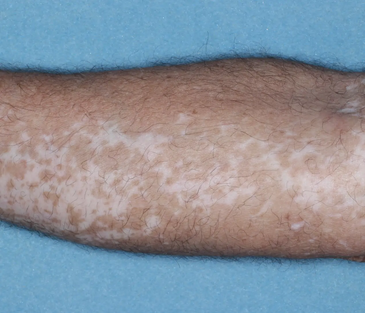 Patient's arm showing repigmentation progress after 1 year of treatment with OPZELURA.