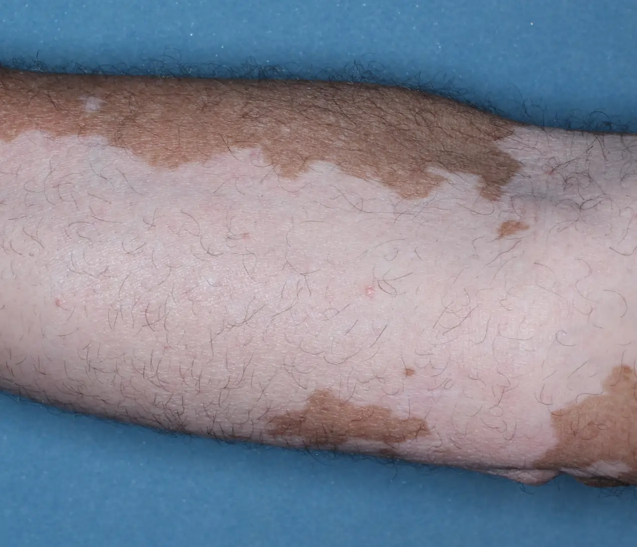 Patient's arm before treatment with OPZELURA.