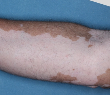 Patient's arm before treatment with OPZELURA.