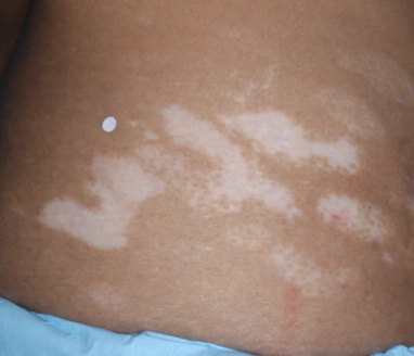 Patient's abdomen before treatment with OPZELURA.
