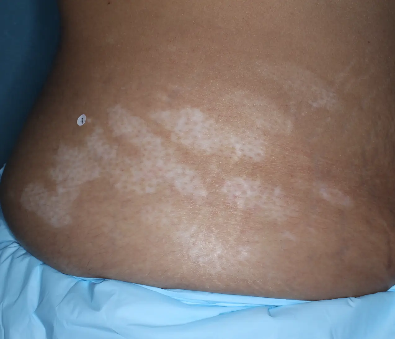 Patient's abdomen showing repigmentation progress after 6 months of treatment with OPZELURA.