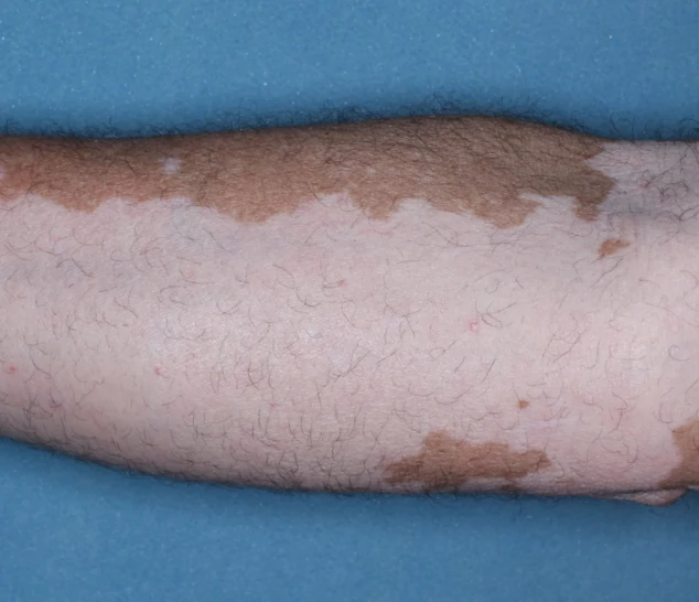 Patient's arm before treatment with OPZELURA.