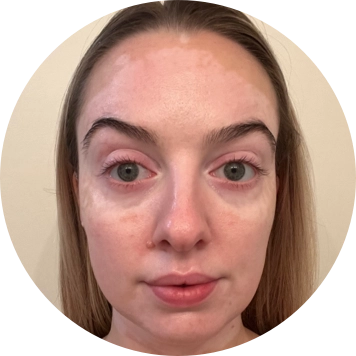 A young woman's face with vitiligo, showing repigmentation progress at 2 months of treatment with OPZELURA.