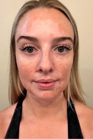 A young woman's face with vitiligo, showing more repigmentation progress at 12 months of treatment with OPZELURA.