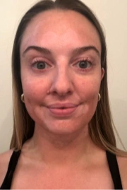 A young woman's face with vitiligo, showing more repigmentation progress at 2 years of treatment with OPZELURA.