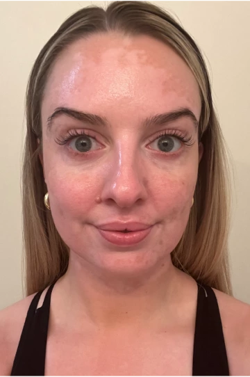 A young woman's face with vitiligo, showing more repigmentation progress at 8 months of treatment with OPZELURA.
