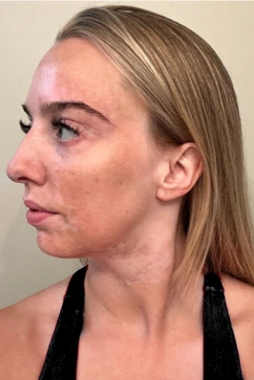 A young woman's face with vitiligo, showing more repigmentation progress at 12 months of treatment with OPZELURA.