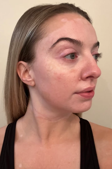 A young woman's face with vitiligo, showing repigmentation progress at 2 months of treatment with OPZELURA.