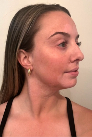 A young woman's face with vitiligo, showing more repigmentation progress at 2 years of treatment with OPZELURA.
