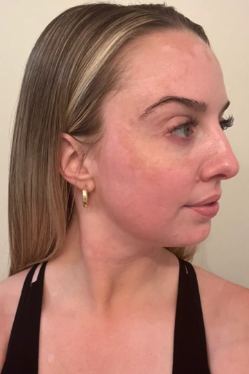 A young woman's face with vitiligo, showing more repigmentation progress at 8 months of treatment with OPZELURA.